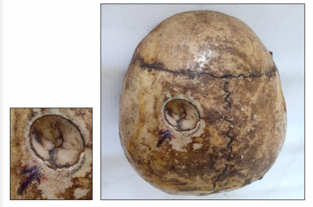 <p>Questions</p><ol><li><p>What is the specimen being examined?</p></li><li><p>What are the type and specific descriptive features of the fracture, including its directional depth indicators?</p></li><li><p>What type of causative instrument and force mechanics produce this injury?</p></li><li><p>How is the time of death estimated?</p></li><li><p>What are the possible causes of death?</p></li><li><p>What is the final diagnosis for this specimen?</p></li></ol><div data-type="horizontalRule"><hr></div><p></p><p></p>