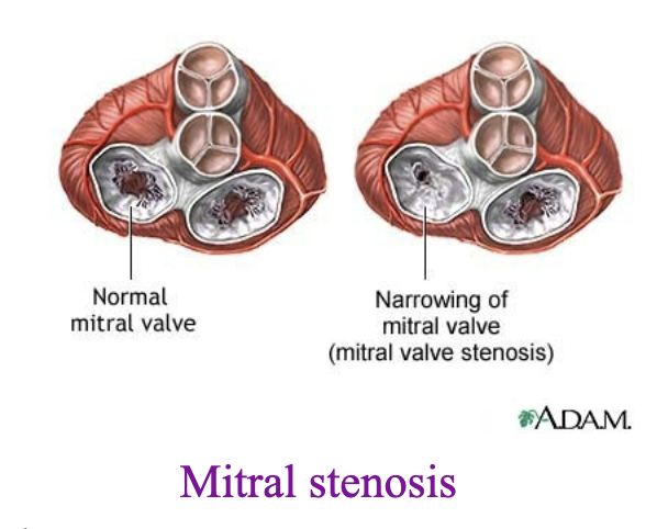 <p>mitral stenosis</p>