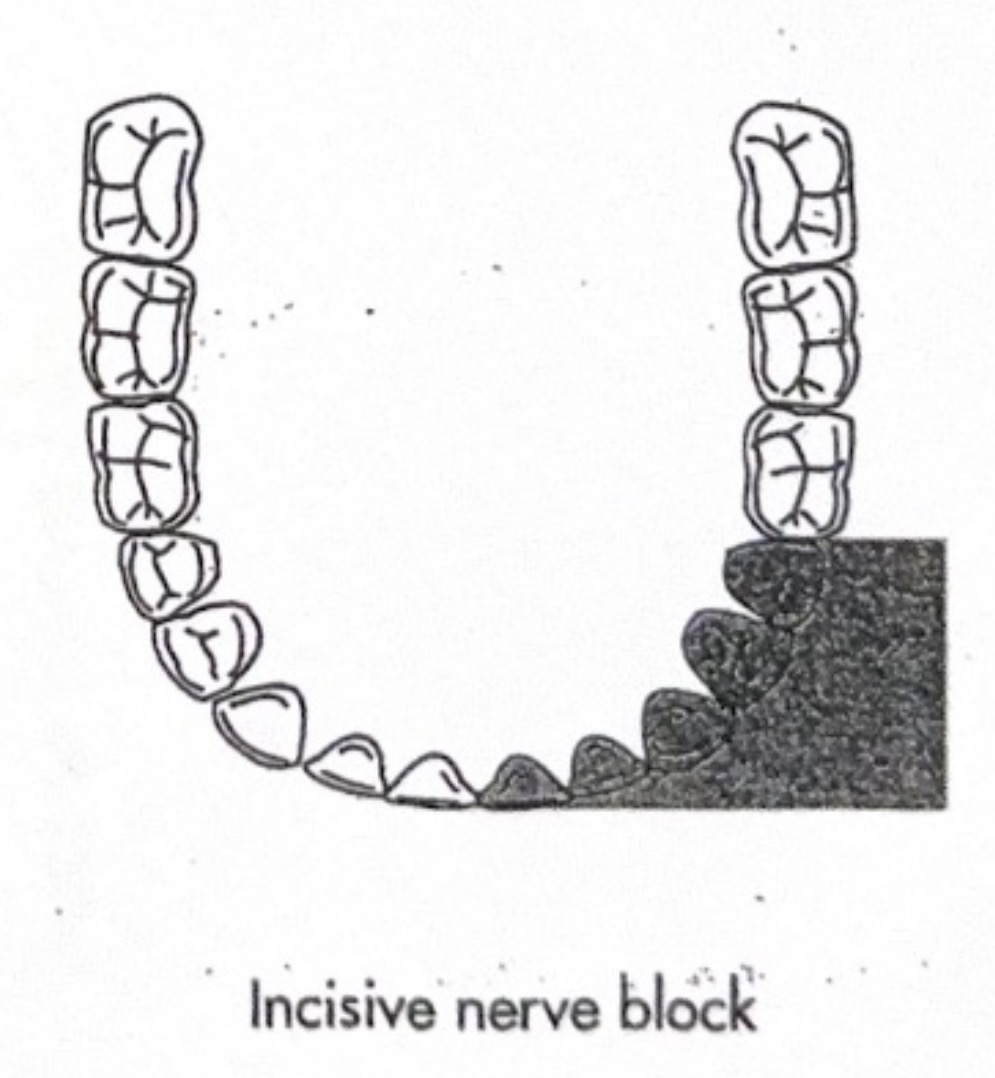 <p>Incisive nerve block</p>