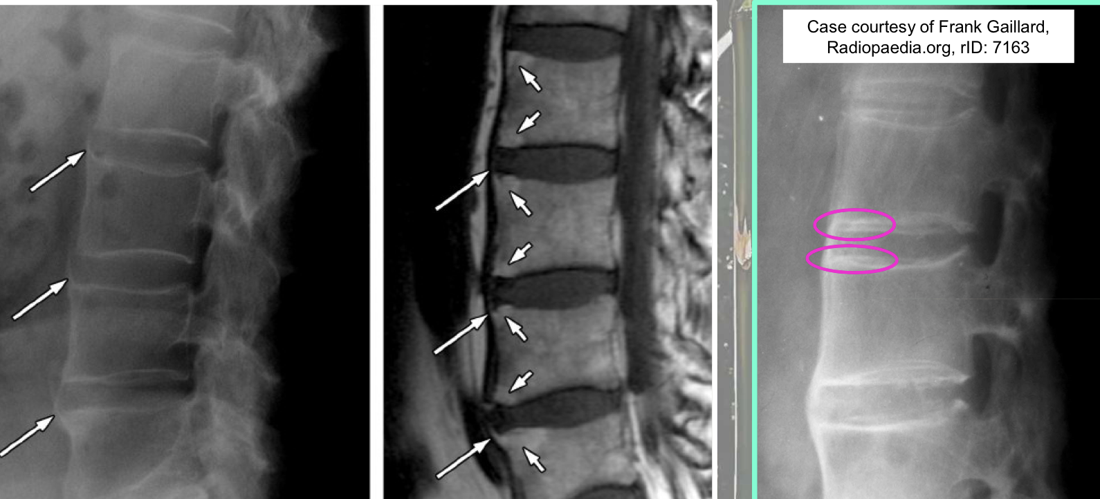 <p>What finding of AS is found in this image</p>