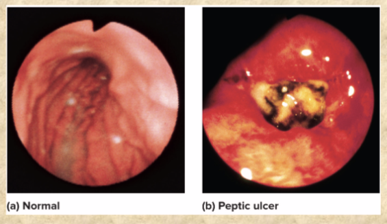 <p>peptic ulcer (mucous coat, tight junctions, epithelial cell replacement)</p>