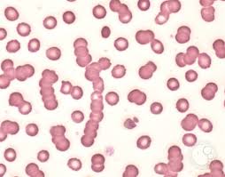 <p>increased amounts of fibrinogen and globulins in plasma result in this lab finding</p>