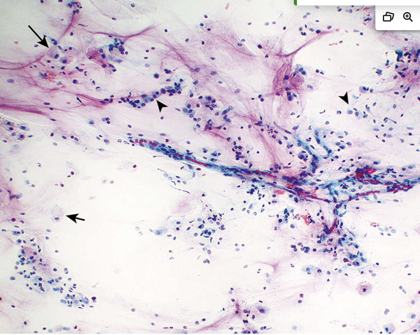 <p>Cytologie salivaire</p><p>1) Catégorie selon Milan</p><p>2) Diagnostic</p><p>3) catégorie si on retrouve que du mucus</p>