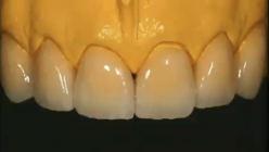 <p>Advantages of feldspathic porcelain?</p>