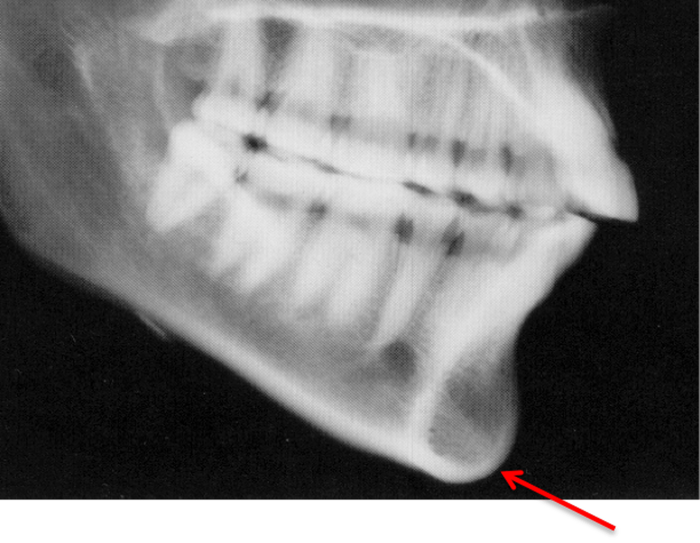 <p>which anatomical landmark:</p><p>- Midpoint between the most anterior and inferior point on the boney chin</p>