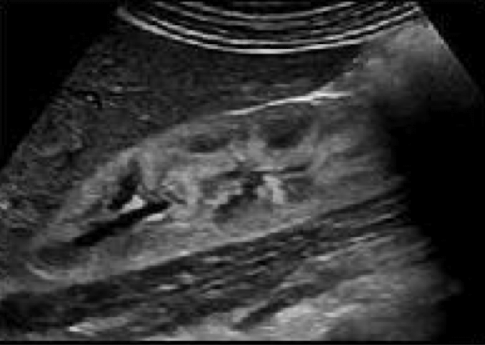 <ul><li><p>necrosis or proliferation occur in glomeruli </p></li><li><p>enlarged poorly functioning kidneys </p></li><li><p><strong>suspected when echogenicity of renal parenchyma exceeds that of liver </strong></p></li></ul><p></p>