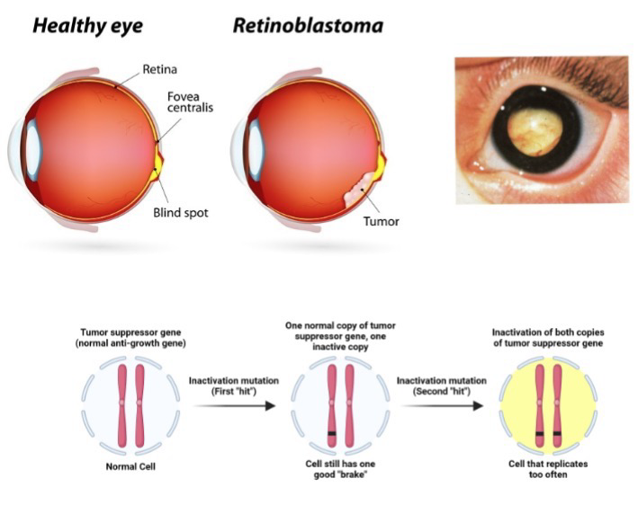 <p>Rb protein is a checkpoint for G1</p><p><strong>Sporadic retinoblastoma</strong>: Patient inherits two good copies of Rb gene; Sporadic tumor in one eye; No additional predisposition to cancer</p><p><strong>Familial retinoblastoma</strong>: Patient inherits one defective Rb gene; Typically has non-clonal tumors in both eyes; ~85% of gene carriers develop tumors (high penetrance)</p><p>During eye development gene errors occur often so Rb mutation is more common</p>
