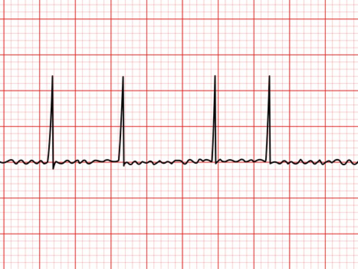 <p><strong>a common, often chronic, heart rhythm disorder where the upper chambers (atria) beat rapidly and irregularly</strong><span>. This quivering reduces pumping efficiency, increasing blood clot and stroke risk, and can cause palpitations, fatigue, and dizziness.</span></p><p></p>