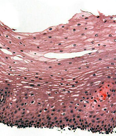 <p>Layers of low epithelium, either has surface terminal cells (vagina, esophagus) or keratin layers (skin)</p>