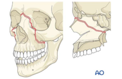 <p>Pyramidal fx from central maxilla through orbital rim, nasal bridge, and hard palate</p><p>*nose and maxilla mobile</p>