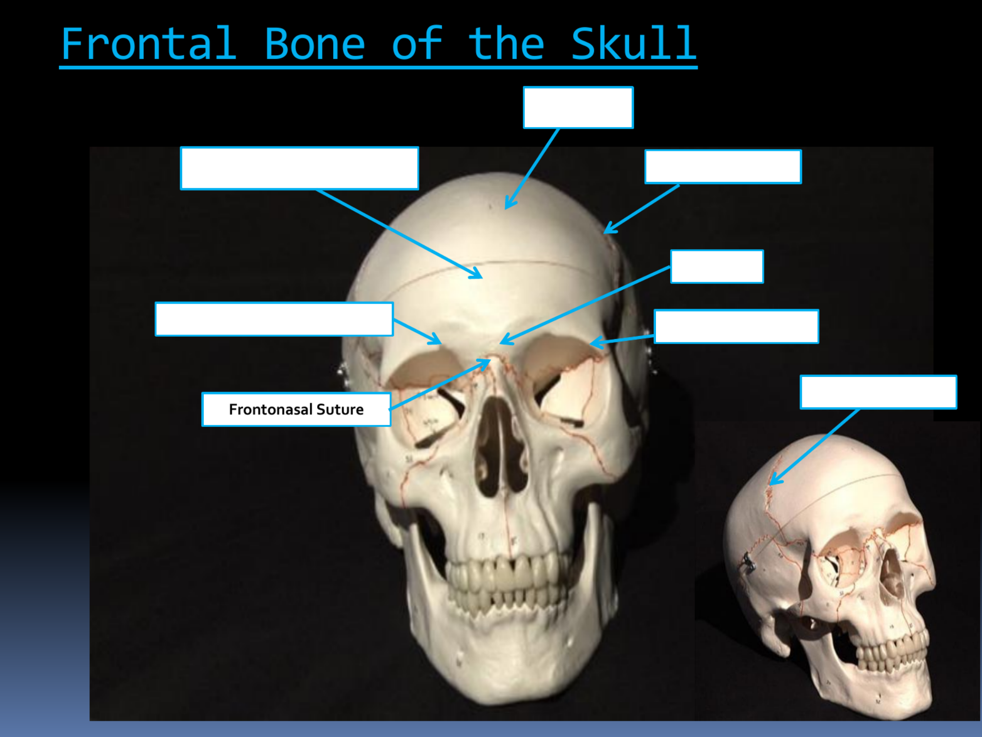 <p>FrontonasalSuture</p>
