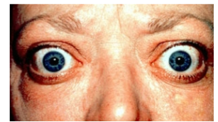 <p>hyperthyroidism </p>