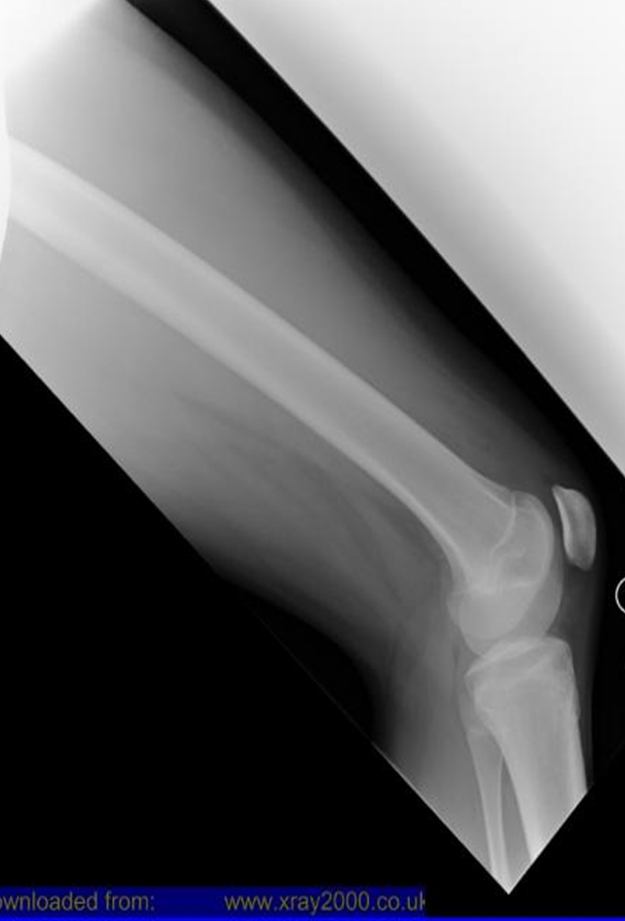 <p>femur in centre of IR diagonally </p>