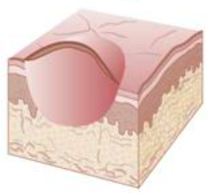 <p>size of a pin head to about<span style="color: red;"> 5mm</span></p><p>solid elevation<span style="color: red;"><strong> less than 0.5cm</strong></span> in diameter</p><p>shape is<span style="color: red;"> round</span> to more or <span style="color: red;">less polygonal</span></p><p>circumscribed <span style="color: red;">superficial elevated</span> areas varying in size</p><p><span style="color: red;">eroded or overlaid</span> surface or <span style="color: red;">moist</span> epithelial desquamation</p>