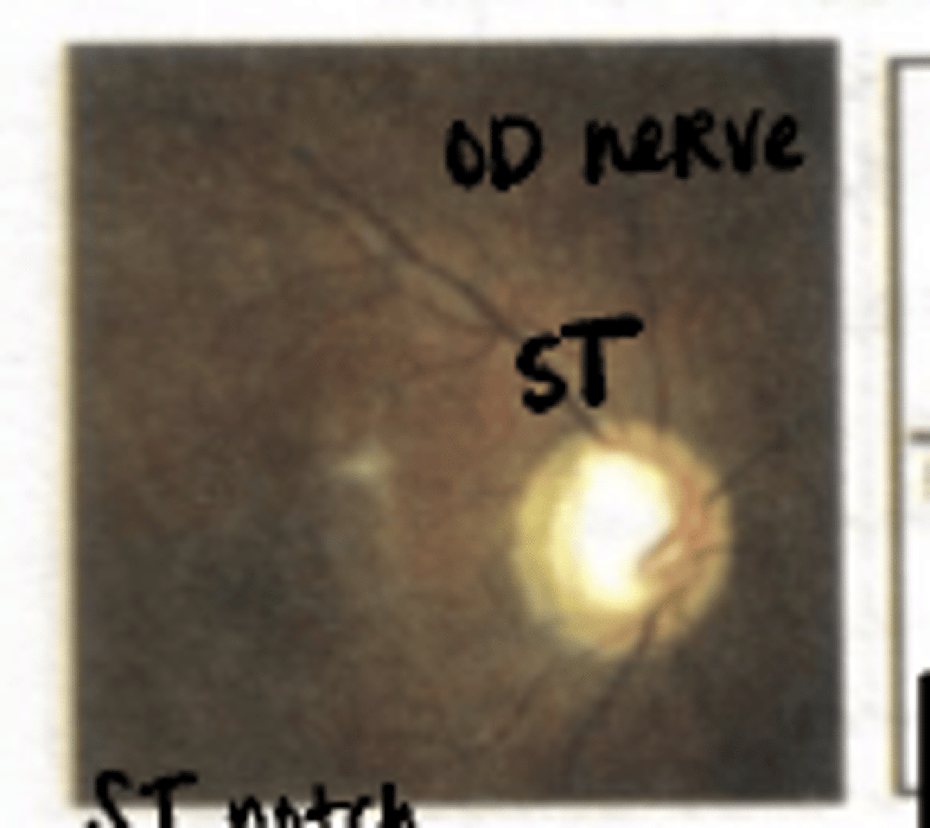 <p>Where is the defect in this ONH?</p>