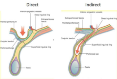 <p>Nonreducible hernia where tissue is trapped outside the abdominal cavity.</p>