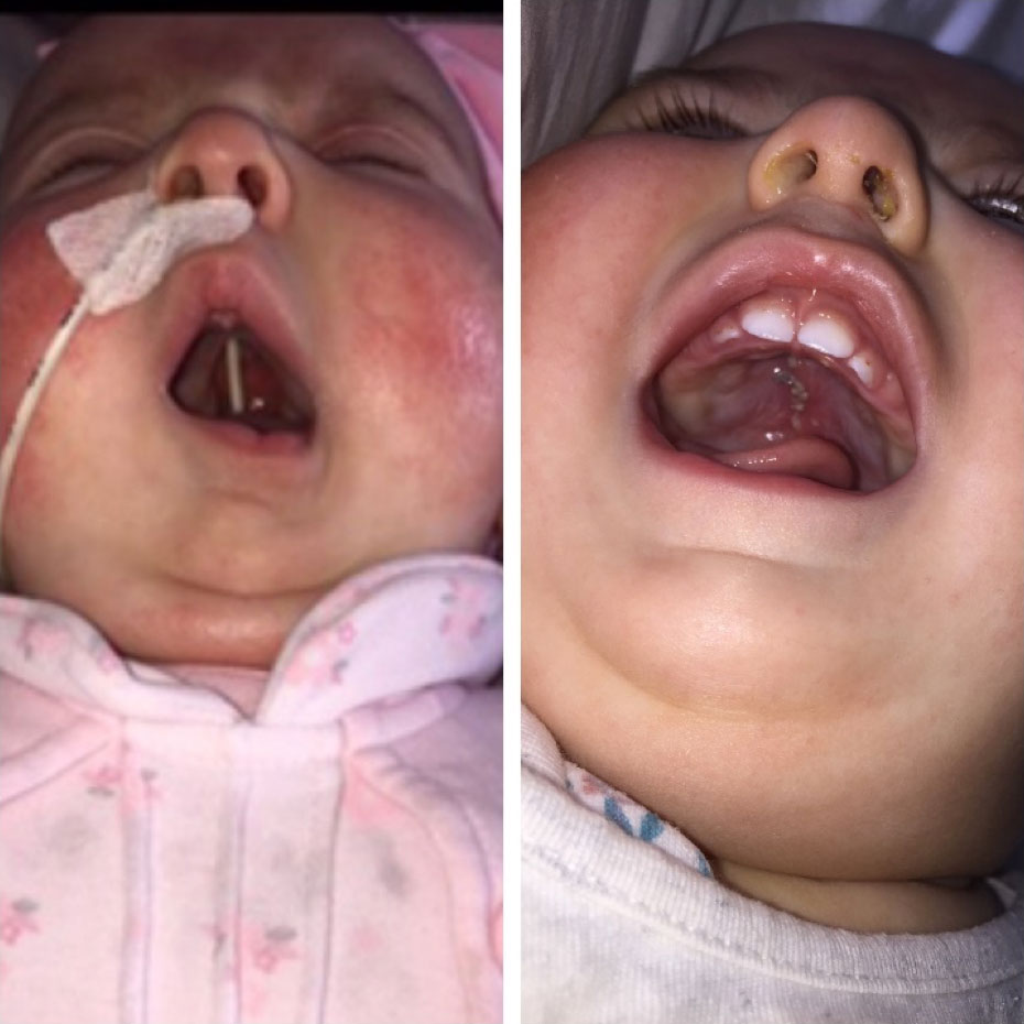<p>A congenital condition characterized by a split or opening in the upper lip and/or roof of the mouth (palate), which can occur separately or together, impacting feeding, speech, and appearance. </p>