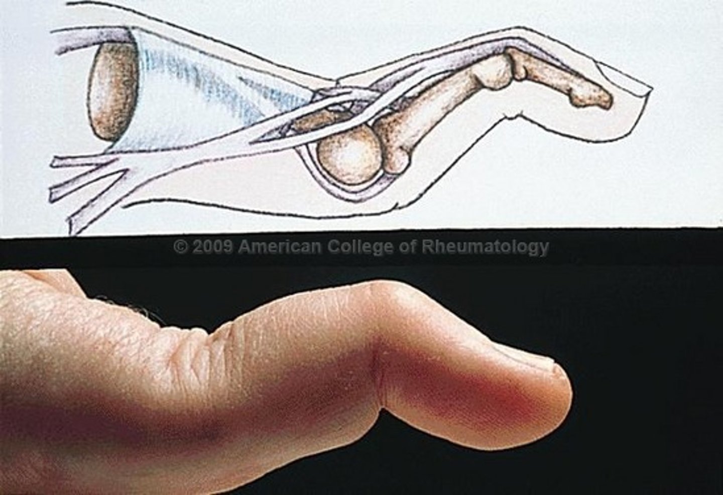 <p>PIP extended &amp; DIP flexed</p><p>-lateral bands slide POSTERIOR</p>