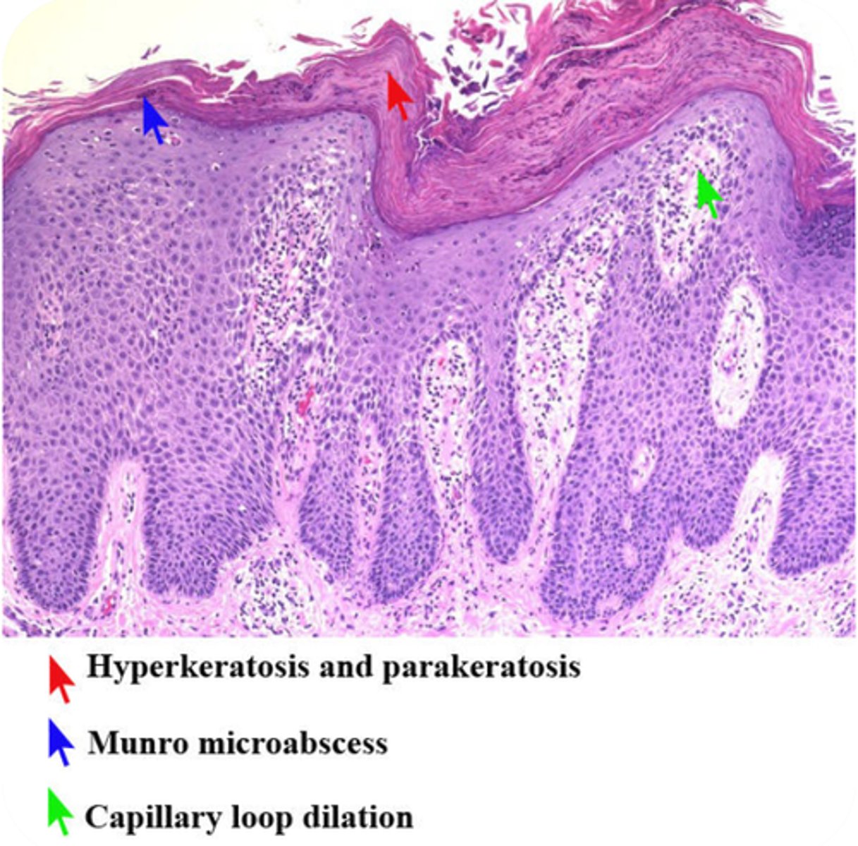 <p>Inflammatory skin disease in which the epidermis is thickened as a result of elongation of rete ridges due to excessive epidermopoiesis (epidermal proliferation)</p>