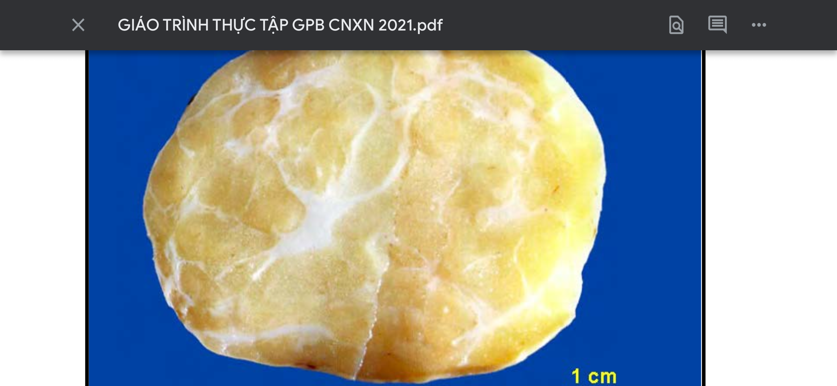 <p>Bệnh lý gì</p>