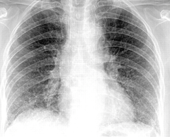 <p>Caused by Pneumocystis jirovecii</p><p>Most common cause of non-bacterial pneumonia in US.</p><p>Transmission: person-to-person respiratory droplets or environmental.</p><p>Symptoms: fungal cells fill the alveoli in lungs and occupy the air spaces, develop a non-productive cough, fever & difficulty breathing. </p><p>Progressed disease leads to consolidation of lungs (formation of a firm dense mass in the alveoli) & respiratory failure.</p><p>Treatment: severe PCP treated with antifungal medications. Usually only those with compromised immune systems develop severe form.</p><p>(Remember picture too!)</p>