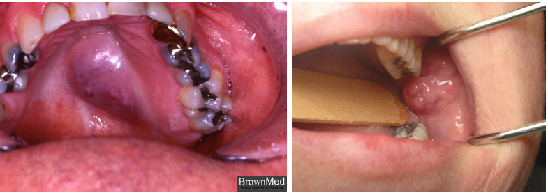 <p>mucoepidermoid carcinoma clinical features</p>