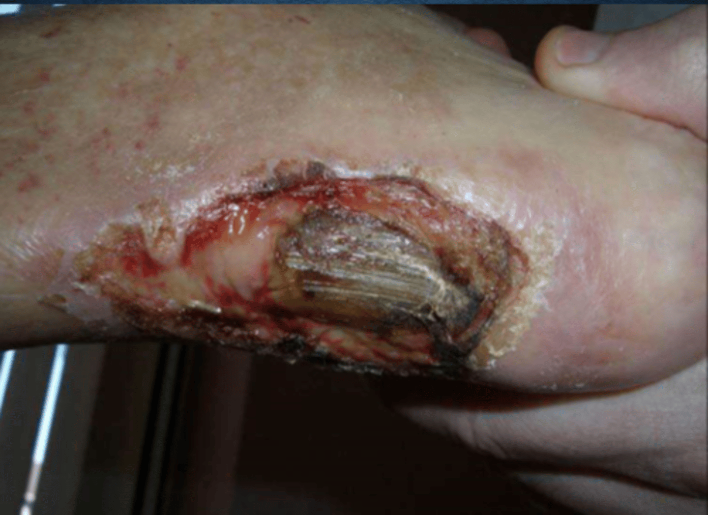 <p>involves the epidermis, dermis, hypodermis, and bone/muscle</p>