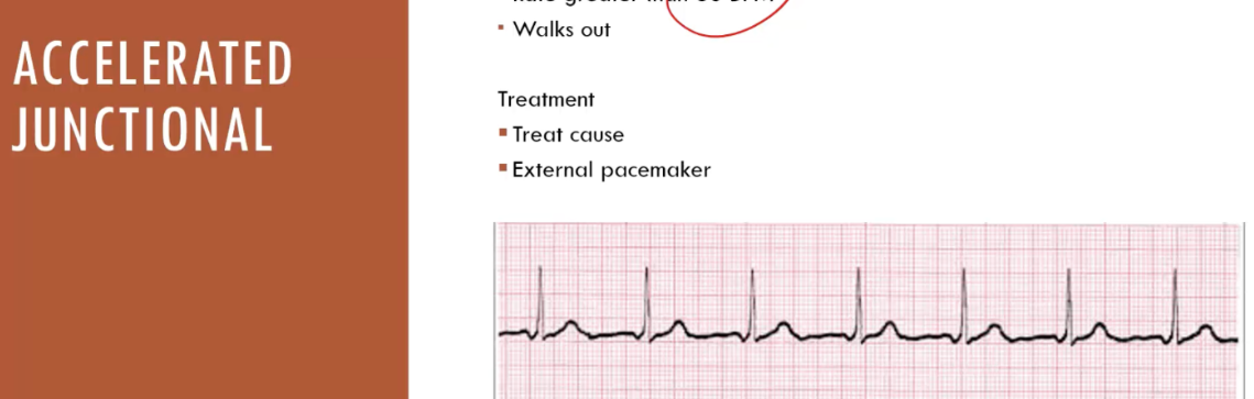 <p>accelerated junctional</p>