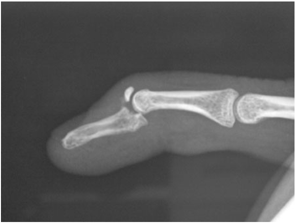 <p>What fracture is shown in the image?</p>