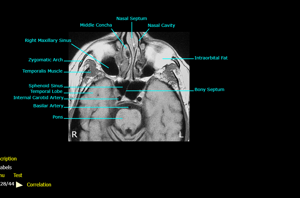 <ol><li><p>Bony Septum</p></li><li><p>Intraorbital Fat</p></li></ol><p></p>