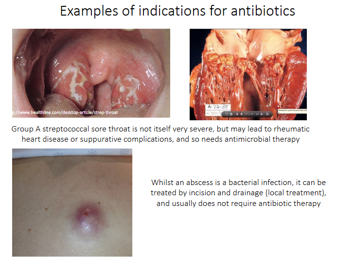 <p>Examples of indications for antibiotics</p>