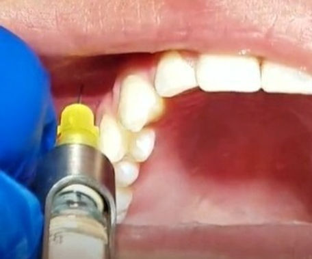 <p>What landmarks are anesthetized with an MSA block?</p><p>teeth & tissues</p><p></p>