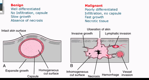 <p>Benign</p><ul><li><p>Well differentiated cells</p></li><li><p>No infiltration, capsule</p></li><li><p>Slow growth</p></li><li><p>Absence of necrosis</p></li></ul><p></p><p>Malignant</p><ul><li><p>Poorly differentiated cells</p></li><li><p>Infiltration, no capsule</p></li><li><p>Fast growth</p></li><li><p>Necrotic tissue</p></li></ul><p></p>
