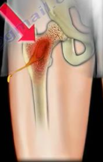 <p><span>the draining sinus</span></p>