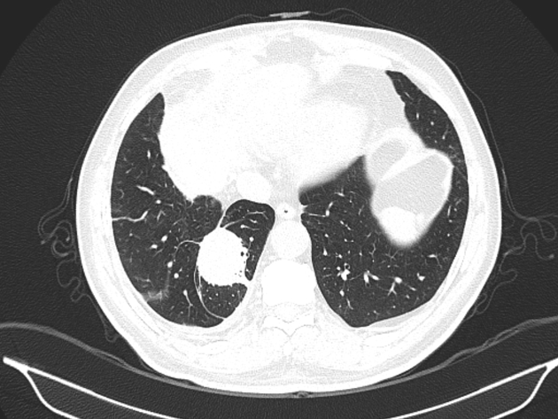 <p>1) Adjacent pleura must be abnormal</p><p>2) Opacity must be peripheral and in contact with pleura</p><p>3) Opacity must be round og elliptical </p><p>4) Volume loss must be present in affected lobe</p><p>5) Pulmonary vessels and bronchi leading into opacity must be curved, leading to focus of atelectasis (comet tail sign).</p>