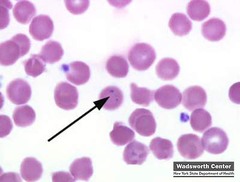 <p>iron particles, faulty iron utilization. Sideroblastic anemias, postsplenectomy, thalassemia, sickle cell anemia, hemochromatosis</p>