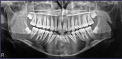 <p>describe the effect of the lesion:</p>