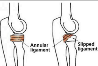 <p>Common injury in children less than 5 years old when the radial head slips out of the annular ligament.</p><p></p><p>Characterized by the annular ligament slipping over the radius bone</p><p></p><p><strong>Symptoms:</strong></p><ul><li><p>Pain the elbow, leading to elbow guarding</p></li><li><p>Reluctance to use the arm</p></li></ul><p></p>
