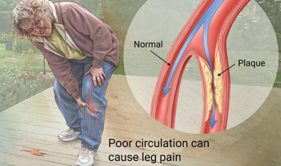<p>Intermittent claudication is the primary symptom of ________; <span>it is characterized by <strong>muscle pain</strong>, cramping, or <strong>fatigue in the legs</strong> (usually the calf) <strong><u>during exercise</u></strong>, caused by reduced blood flow due to atherosclerosis, which is <strong><u>relieved by rest</u></strong></span></p>