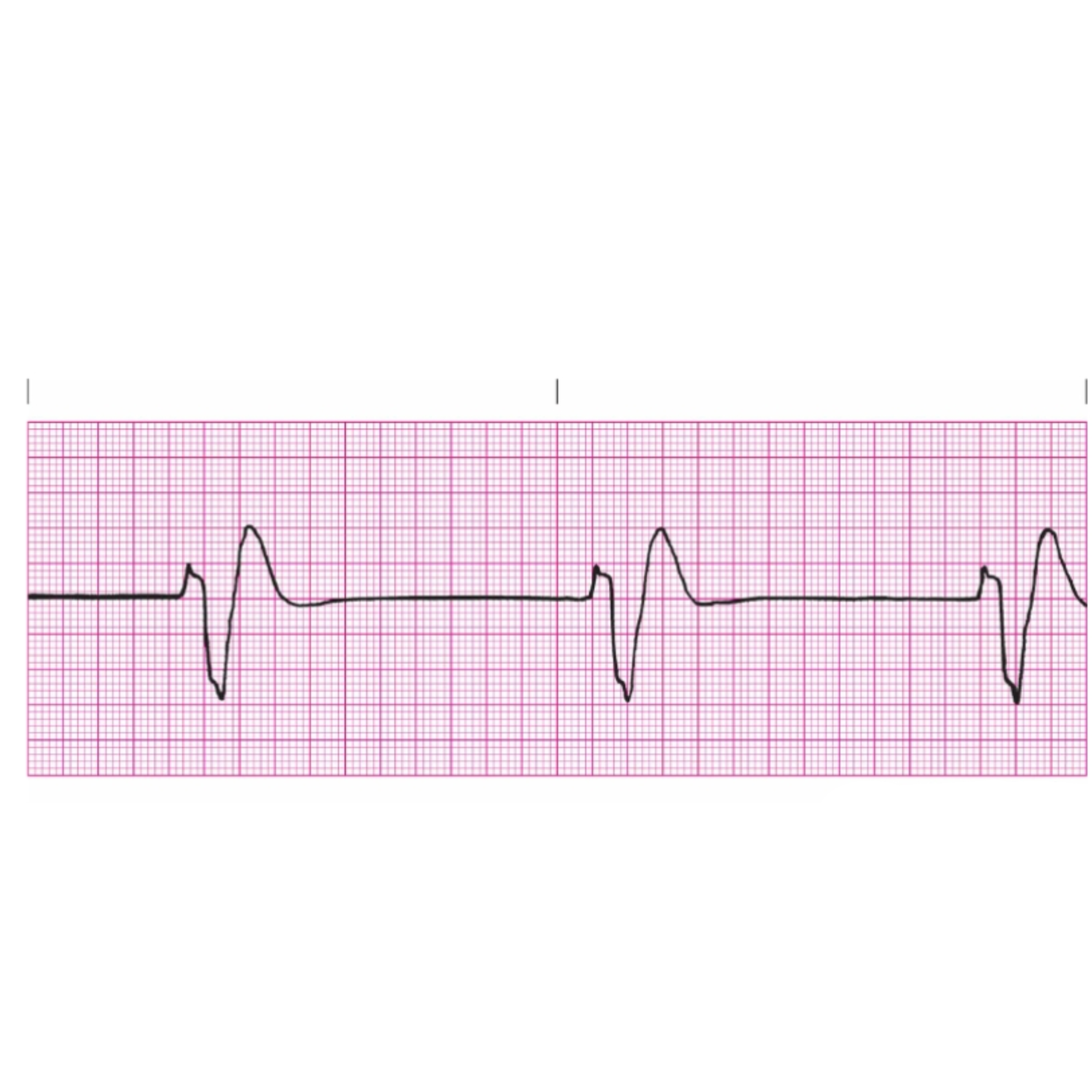 <p>Rules for Idioventricular Rhythm</p>