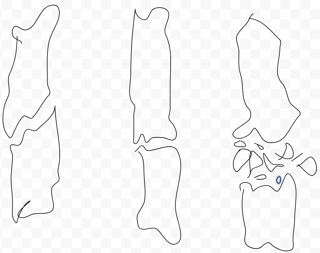 <p>what fracture is the left one?</p>