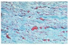 <p>what kind of cardiac muscle injury?</p>