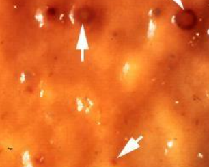 <p>What group of intestinal parasites in horses are small strongyles which live in the colon as adult worms and encyst in the gut wall, causing damage and diarrhea when the larvae hatch out? Hatching usually occurs in late winter and early spring. Diagnosis is with FEC/FECRT, hypoproteinemia, and response to deworming (moxidectin, ivermectin, fenbendazole, pyrantel).</p>