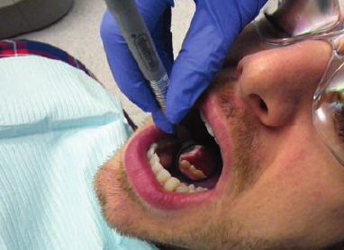 <ul><li><p>1 to 2 o’ clock position</p></li><li><p>Rest finger on right side of patient’s face</p></li><li><p>Use mirror to move tongue away from teeth, so lingual surfaces of teeth can be seen. Once in position, view distal, lingual, and mesial surfaces in mirror’s reflecting surfaces</p></li></ul><p></p>