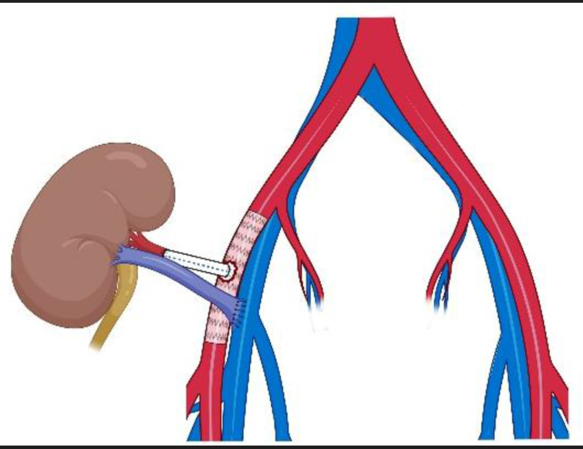 <p>recipient external iliac artery and vein</p>