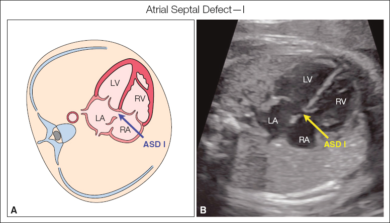 <p>Absence of part of the atrial septum</p><p>Color Doppler is helpful at detecting small defects</p>