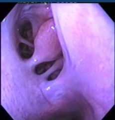 <p>What is this on an endoscope?</p>