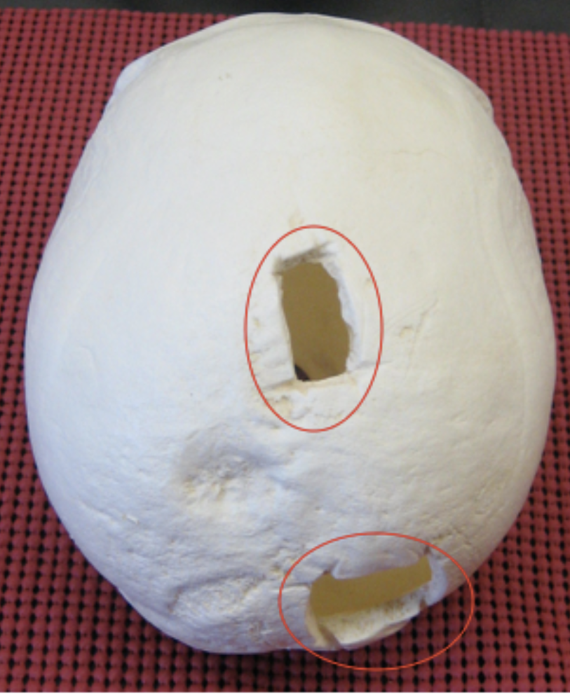 <p>is this injury antemortem, perimortem, or postmortem?</p>