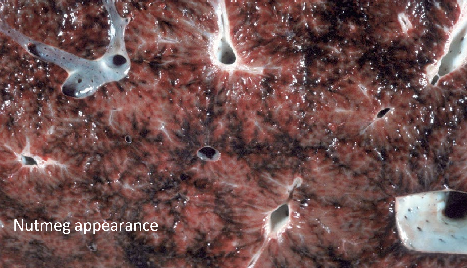 <p>What is the lesion associated with <strong><u>chronic</u></strong> passive congestion of the liver?</p>