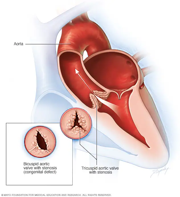 <p>narrowing at the <strong>aortic valve</strong>/outflow that obstructs blood leaving the left ventricle </p>